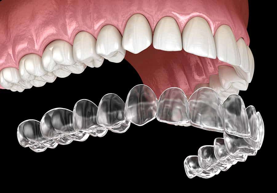 Illustration of a Teeth and Invisalign — Dentist in Palm Beach, QLD