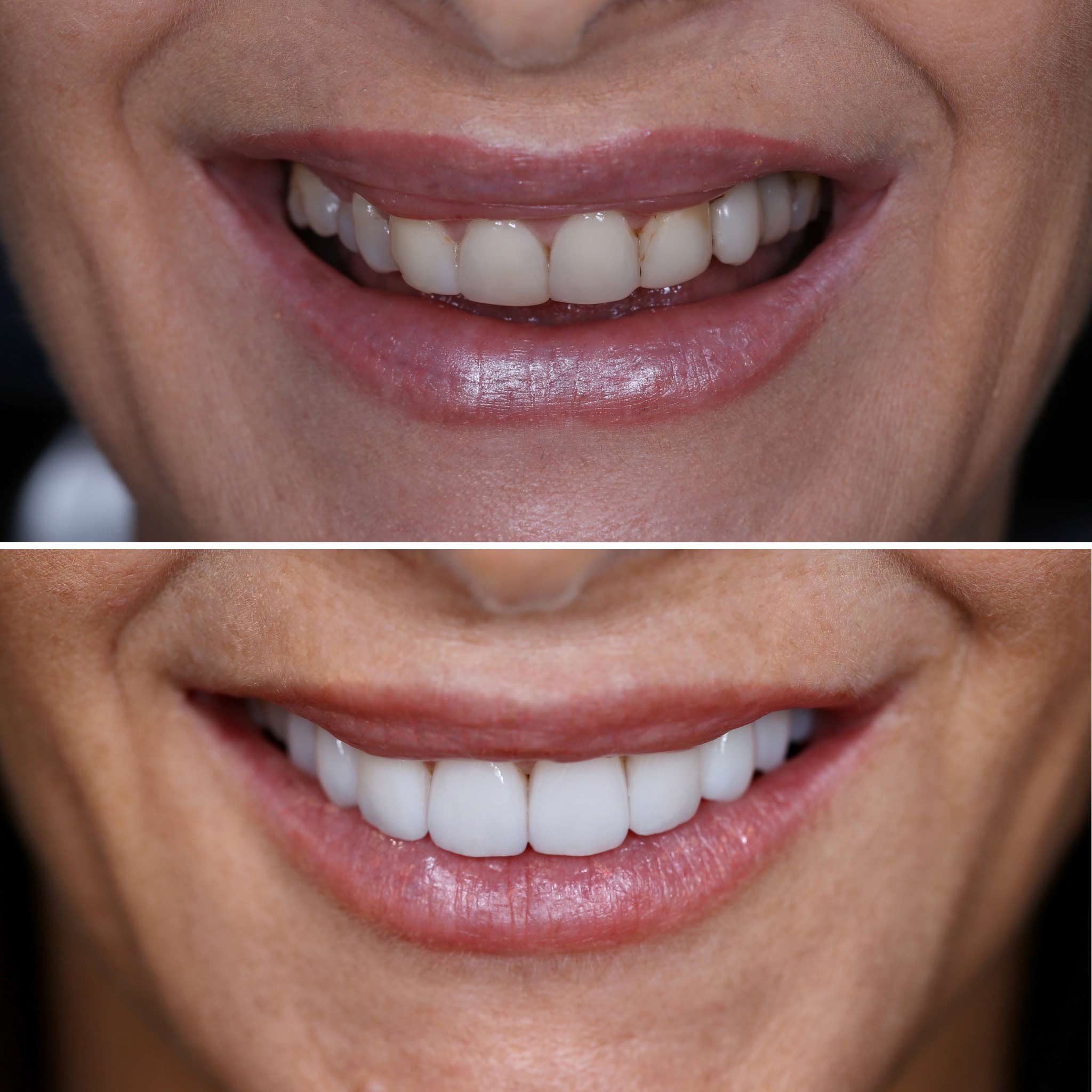Before and After of a Woman's Teeth — Dentist in Palm Beach, QLD