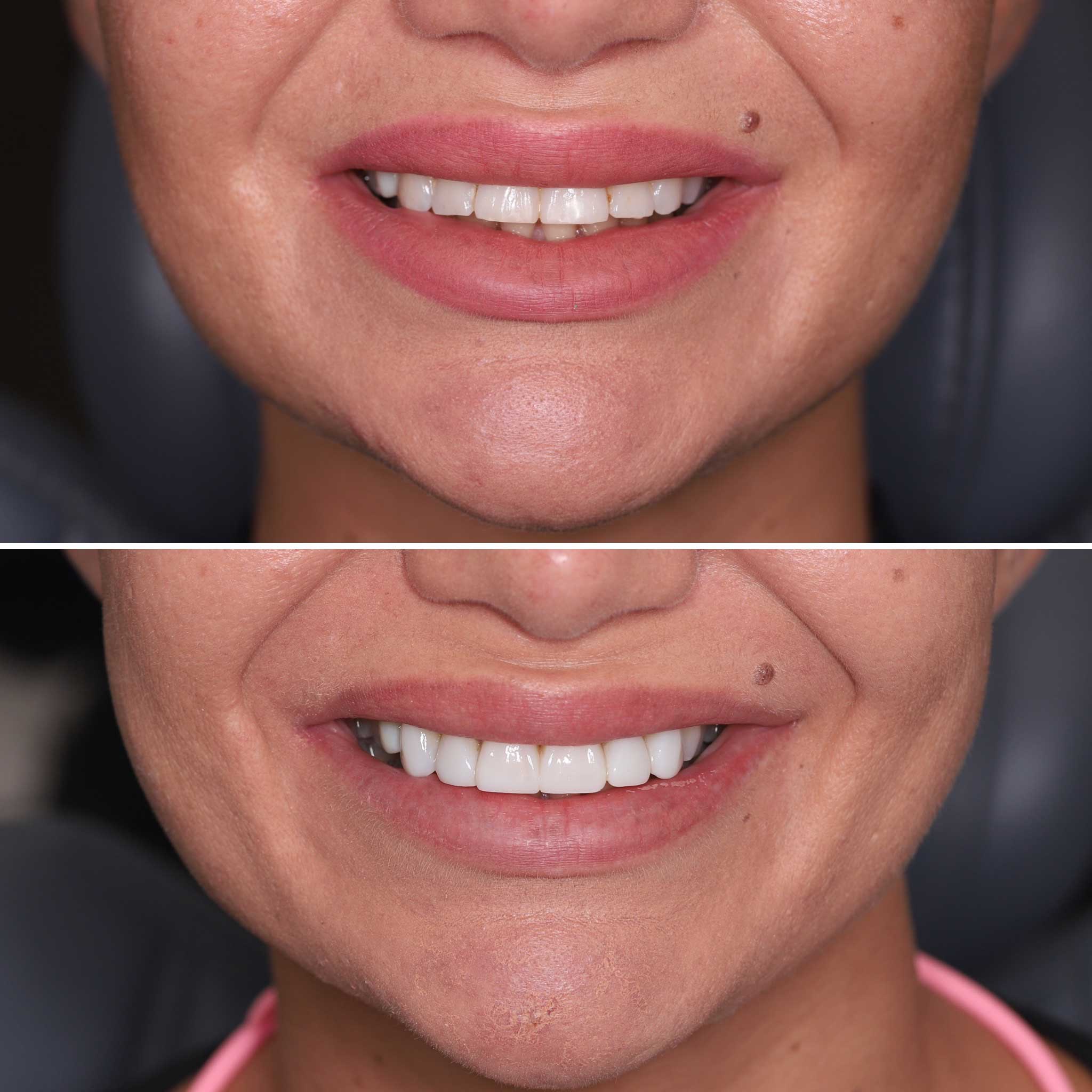 Before and After of a Woman's Teeth Treatment — Dentist in Palm Beach, QLD