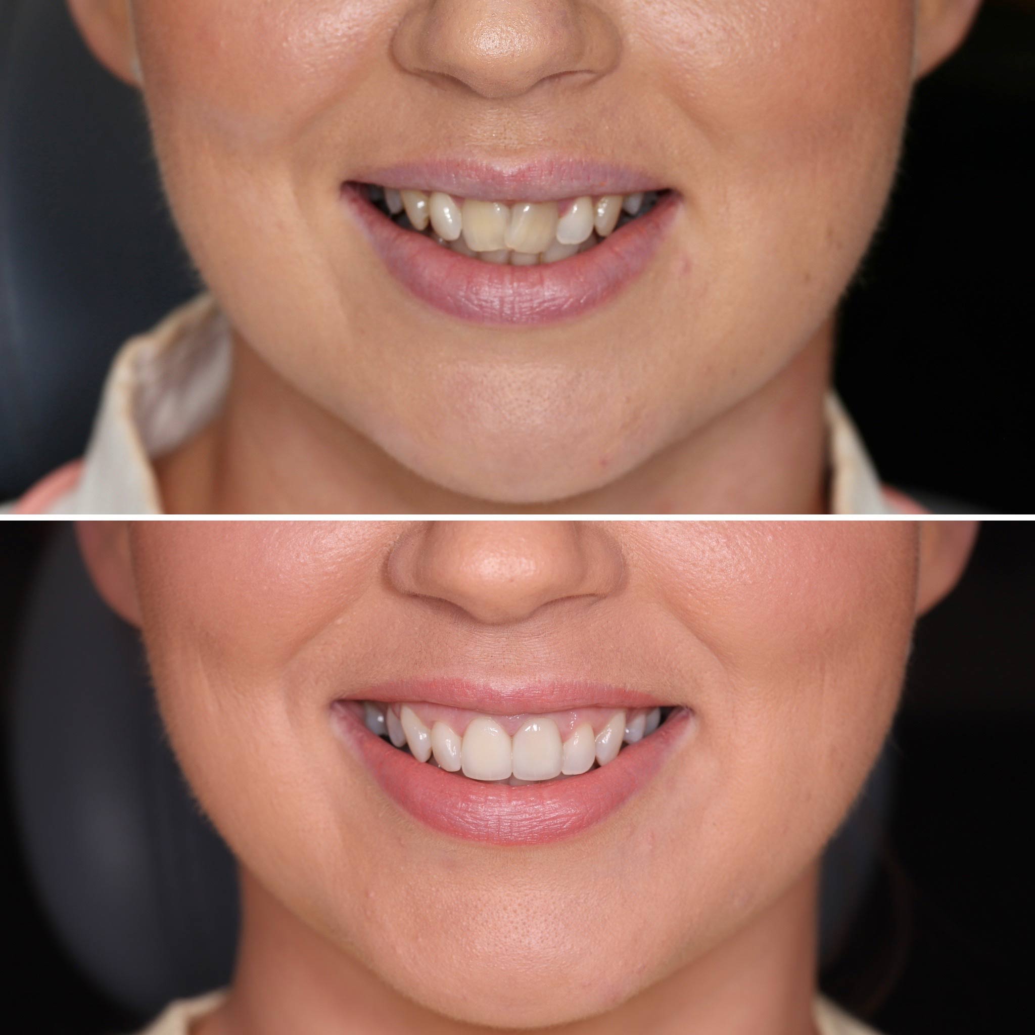 Before and After of a Child's Teeth — Dentist in Palm Beach, QLD