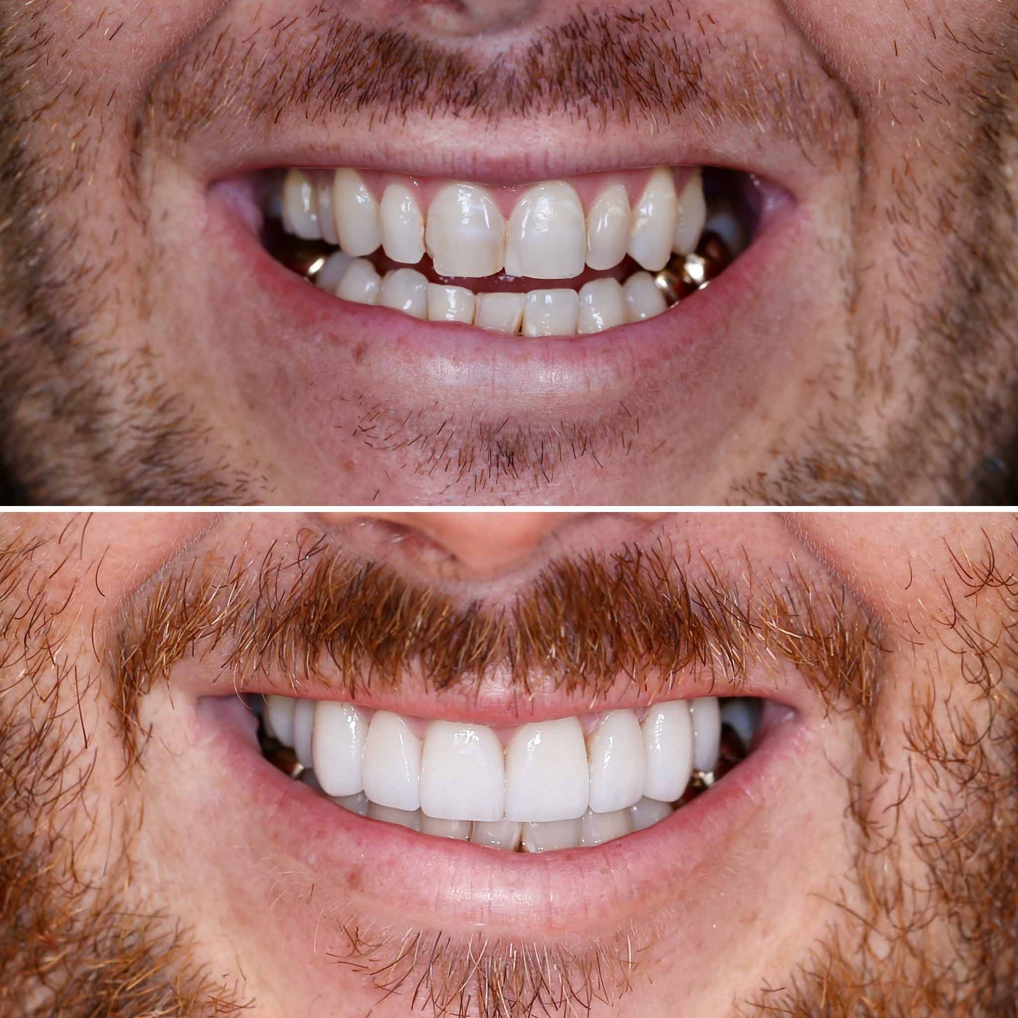 Before and After of a Man's Teeth — Dentist in Palm Beach, QLD