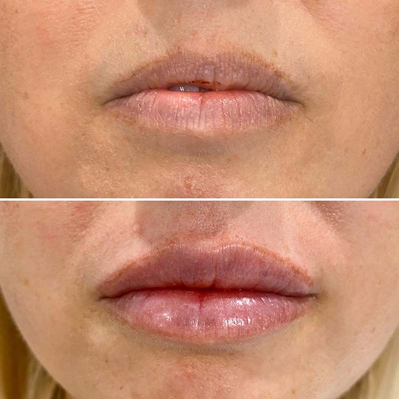 Before and After Facial Injectables — Dentist in Palm Beach, QLD
