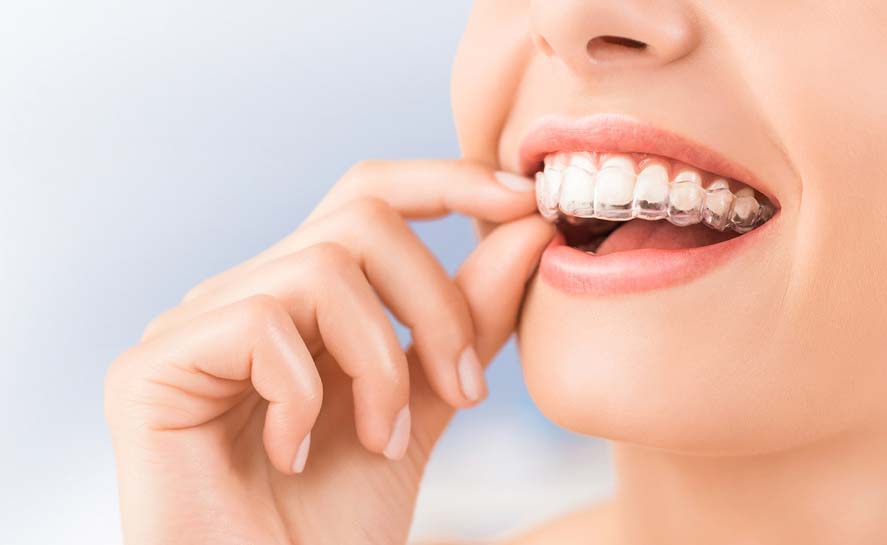 A Woman Wearing Invisalign — Dentist in Palm Beach, QLD