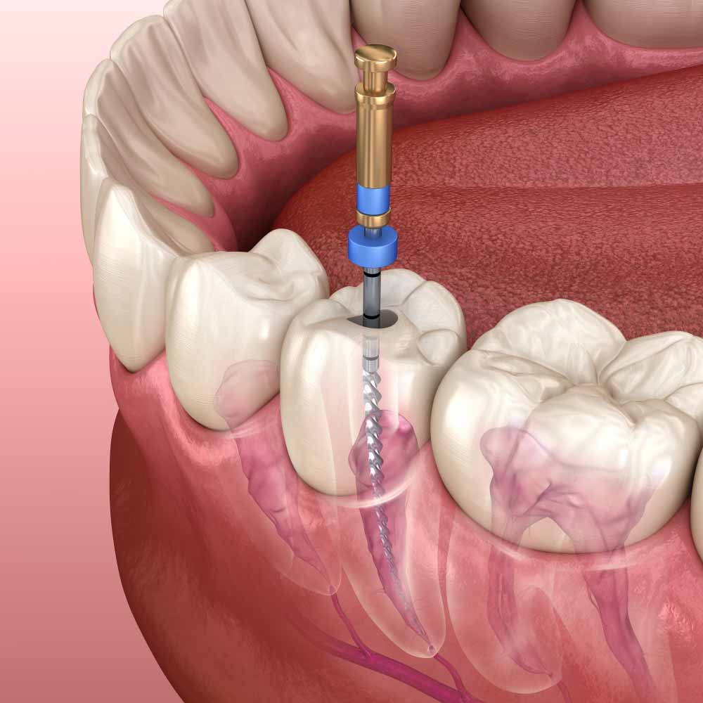 3D Illustration Of Root Canal Treatment Process