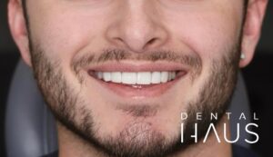 Man With New Dental Veneers