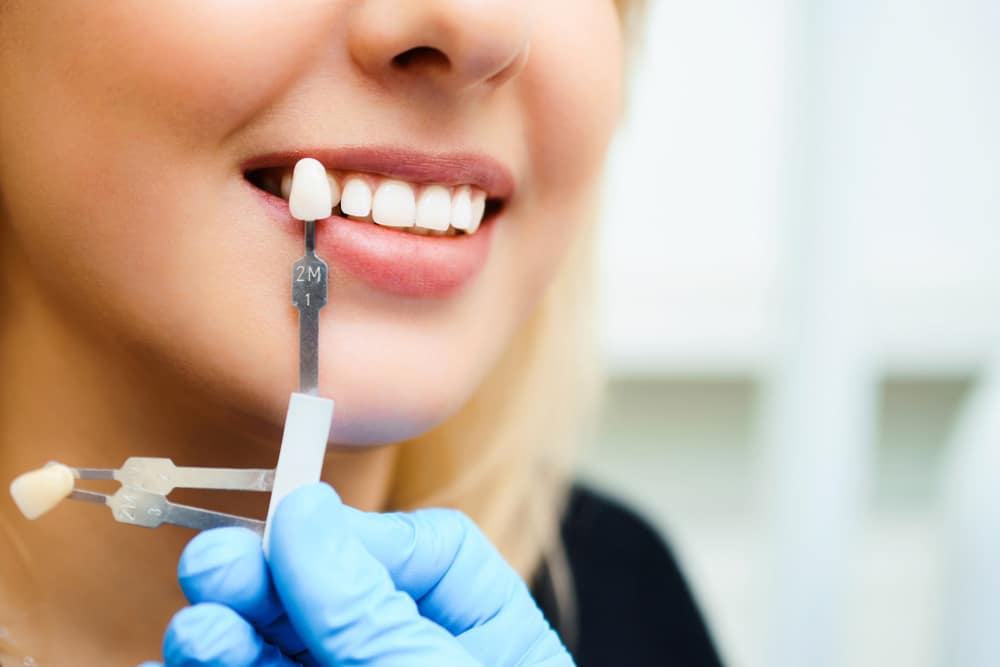 Choosing Right Shade for Cosmetic Dentistry