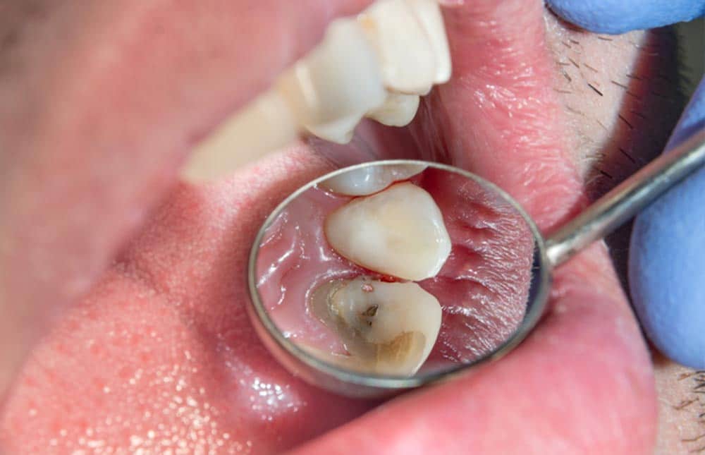 Dentist Checking On A Decaying Tooth