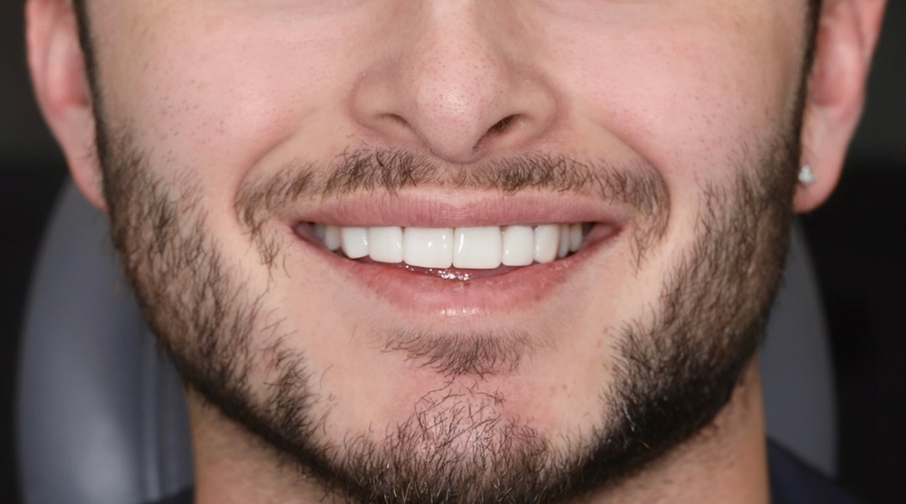 An After Porcelain Veneers In Gold Coast