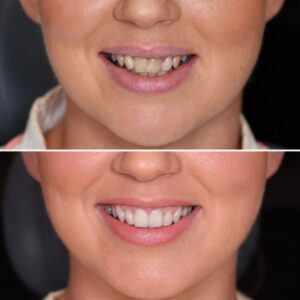 Before And After Smile Transformation By A Dentist Palm Beach