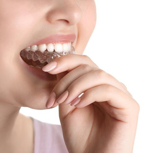 Woman Putting Occlusal Splint In Mouth — Dentist in Palm Beach, QLD