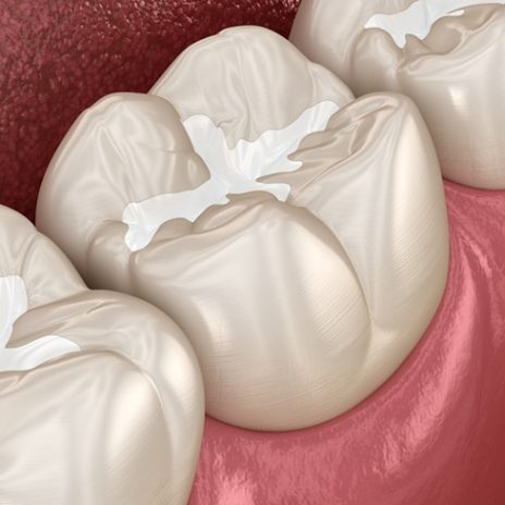 Molar Fissure Dental Fillings — Dentist in Palm Beach, QLD