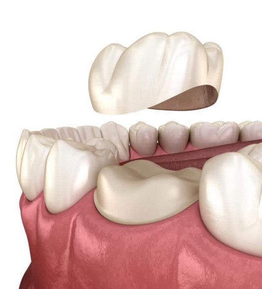 3D Illustration Of Dental Crown