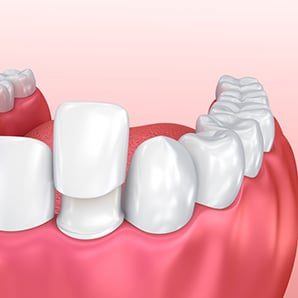 A graphic showing how dental veneers are applied