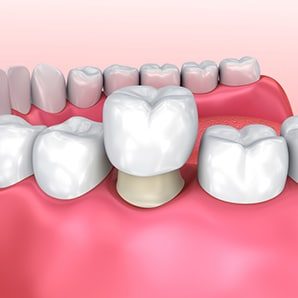 Dental Crown Installation Process — Dentist in Palm Beach, QLD