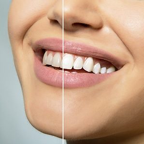 Split image of Teeth Before and After Zoom Teeth Whitening on the Gold Coast