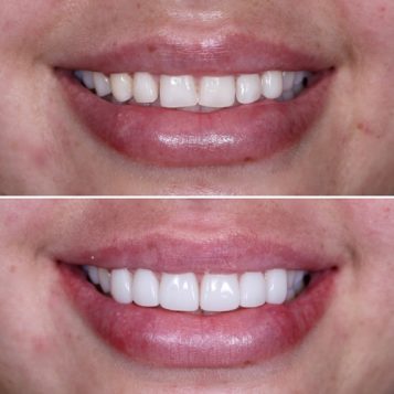 Close Up Composite Veneers on a patient at Dental Haus