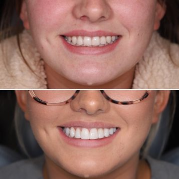 Composite dental Veneers completed on a Woman's mouth at Dental Haus