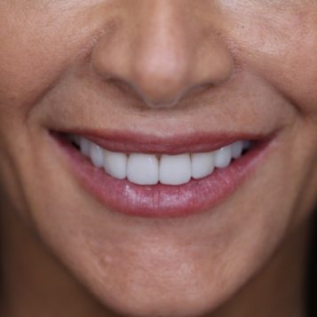 A client's mouth after professional teeth whitening in chair at the Gold Coast Dental Clinic