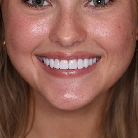 Mouth Guard for Teeth Griding in Palm Beach | Dental Haus