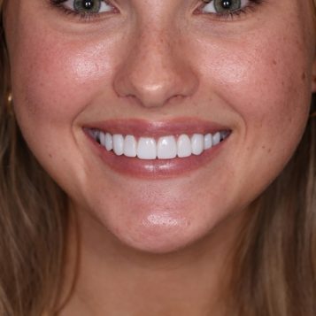 A client smiling showing her new dental veneers