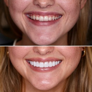 Before and after Non Prep Veneers on a woman at Dental Haus in Palm Beach