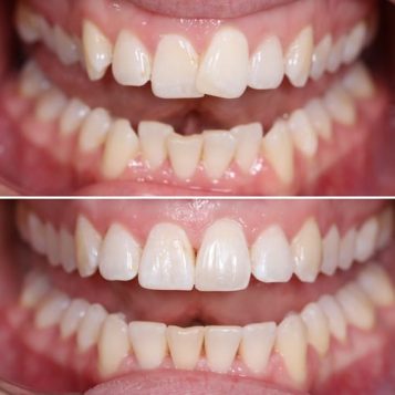 Before and After Orthodontic Treatment — Dentist in Palm Beach, QLD