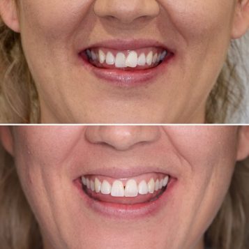 Before and After Orthodontic Treatment of Woman — Dentist in Palm Beach, QLD