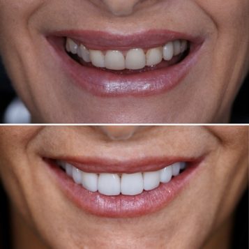 Porcelain Veneers completed on a woman's mouth at Dental Haus