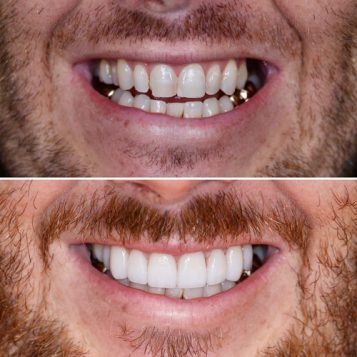 Porcelain Veneers completed on a Man's mouth at Dental Haus