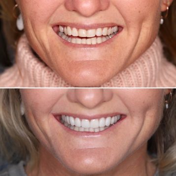 Porcelain Veneers before and after on a ladies mouth at Dental Haus