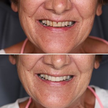 Before and After Same-day Crowns of Woman — Dentist in Palm Beach, QLD