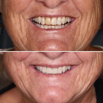 Before and After Same-day Crowns of Lady — Dentist in Palm Beach, QLD