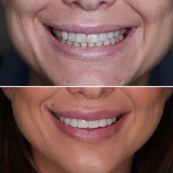 Before and After of a Ladies Smile Makeover at Dental Haus in Palm Beach