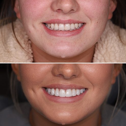 Before and After quality dental veneers from Dental Haus on the Gold Coast