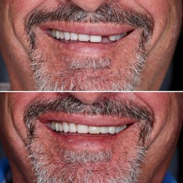 Before and After of a Man's Teeth after a dental makeover al Dental Haus