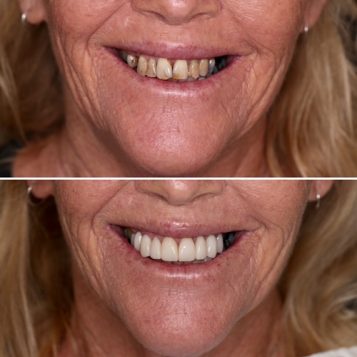 Before and After of a Woman's Smile Makeover on the Gold Coast