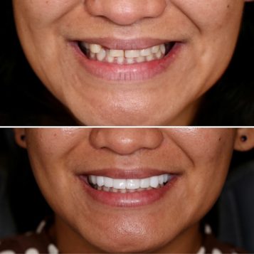 Before and After of a Woman's full Smile Makeover on the Gold Coast at Dental Haus