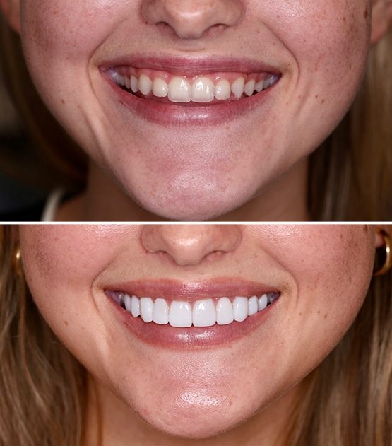Before and After of Dental Veneers — Dentist in Palm Beach, QLD