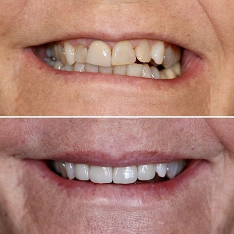 Before and after affordable Dental Veneers on the Gold Coast from Dental Haus