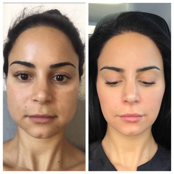 Bruxism in Palm Beach Dental Haus