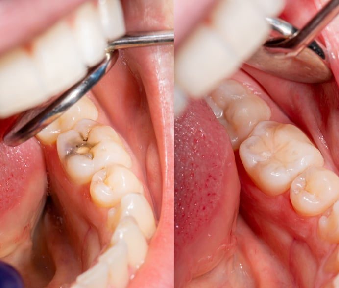 Before and After Replacement Filings — Dentist in Palm Beach, QLD